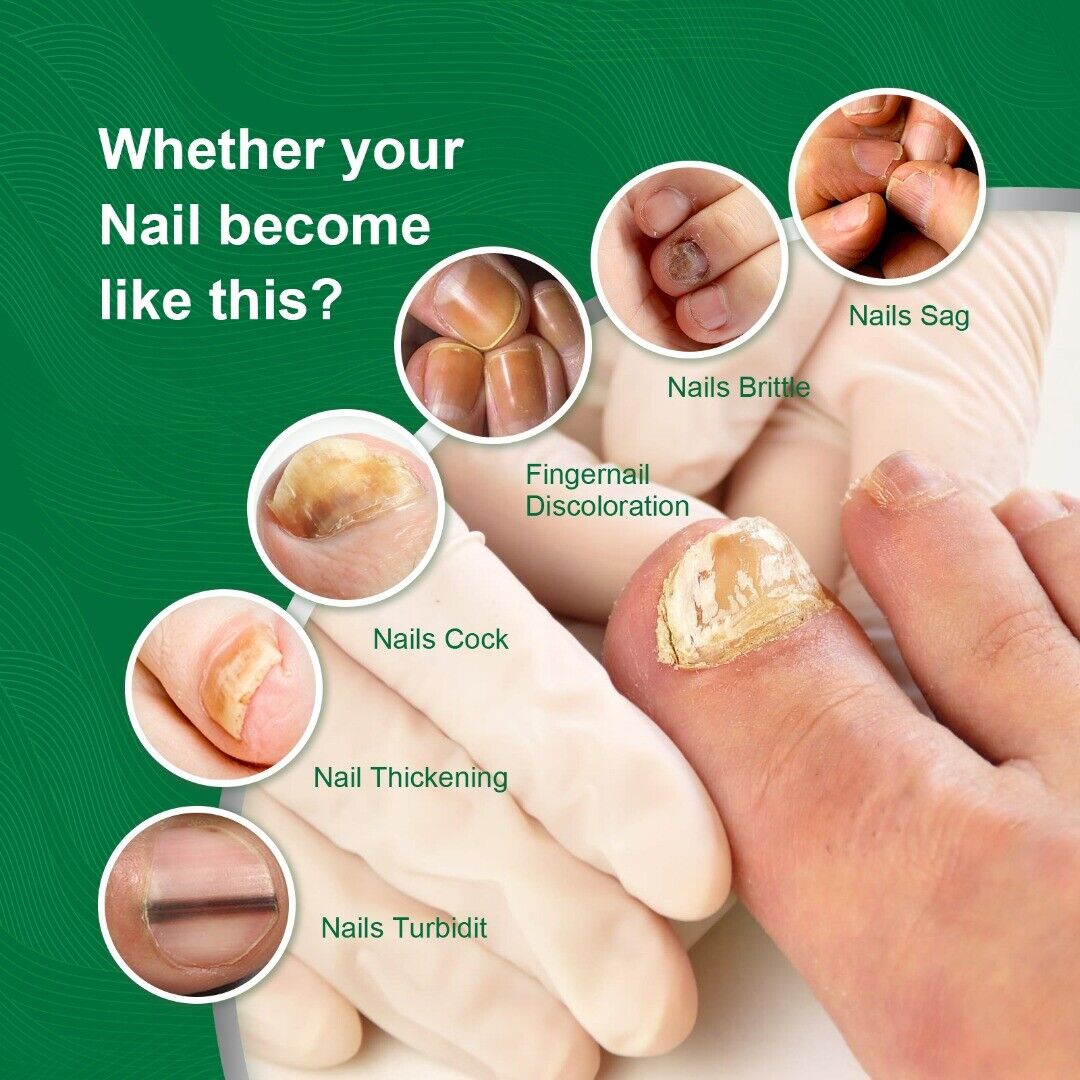 OUHOE Sprej protiv gljivičnih infekcija na noktima